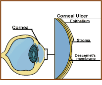 A drawing of a corneal ulcer